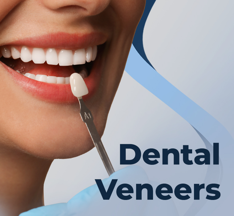Dental Veneers